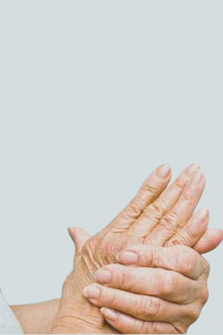 hand Arthritis image 